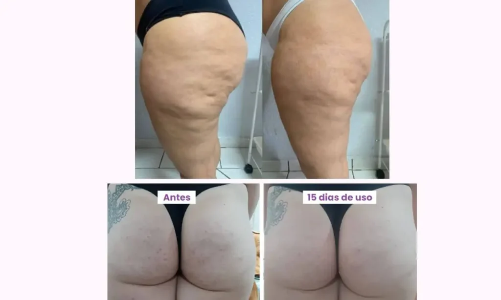 creme-anticelulite-BumBum-Cream-antes-depois-1024x614 Bum Bum Cream Funciona Mesmo ou É Só Hype e Marketing de Influenciador?
